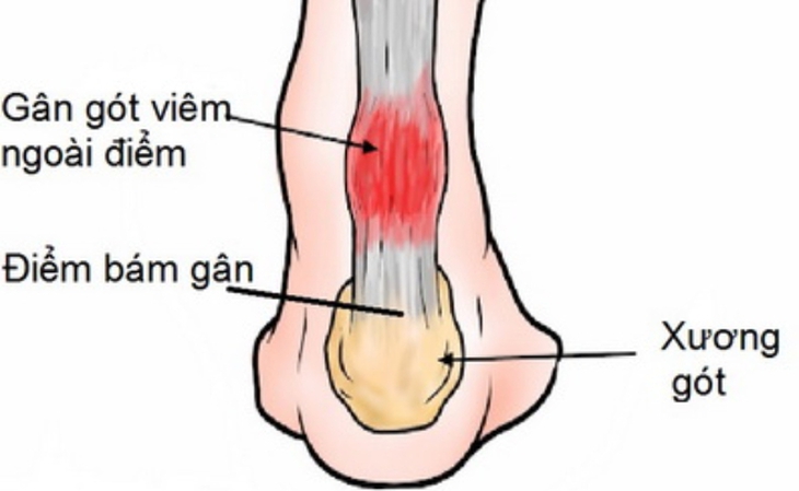 Gân Achilles là gân lớn nhất trong cơ thể con người. Gân Achilles là gân lớn nhất trong cơ thể con người.