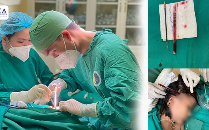 Bé gái 4 tuổi nhập viện cấp cứu với cây bút còn ghim trong đầu