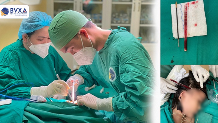 Bé gái 4 tuổi nhập viện cấp cứu với cây bút còn ghim trong đầu- Ảnh 2.