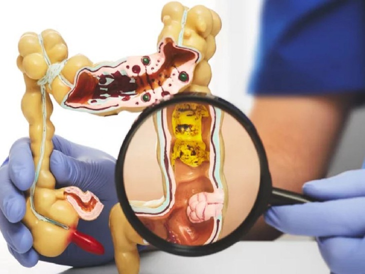 4 điều cần biết khi khám sàng lọc ung thư đại trực tràng- Ảnh 1.