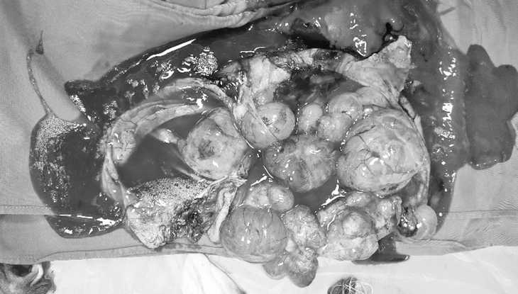 Nghĩ béo bụng, người phụ nữ bàng hoàng khi phát hiện khối u buồng trứng nặng gần 13kg- Ảnh 3.