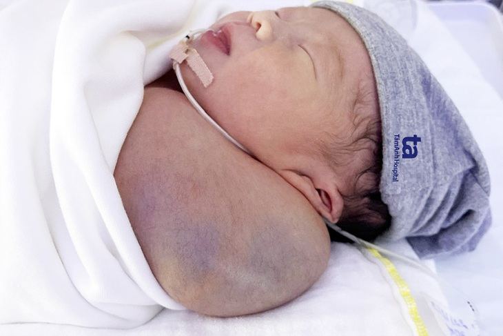 3 cuộc đại phẫu cứu bé trai có khối u nặng bằng 1/3 trọng lượng cơ thể- Ảnh 1.