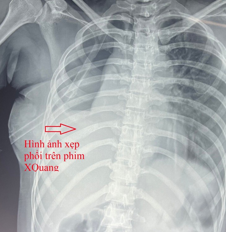 9 giờ cam go bác sĩ giành giật mạng sống cho người phụ nữ bị tai nạn đứt rời phế quản- Ảnh 1.
