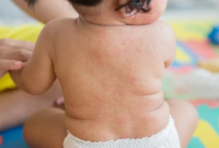 Để chẩn đoán bệnh sốt siêu vi, bác sĩ có thể sẽ tìm cách loại trừ nhiễm trùng do vi khuẩn qua xem xét các triệu chứng và tiền sử bệnh cũng như thực hiện các xét nghiệm máu hoặc lấy các mẫu bệnh phẩm như nước bọt hoặc chất dịch cơ thể. Ảnh minh họa Để chẩn đoán bệnh sốt siêu vi, bác sĩ có thể sẽ tìm cách loại trừ nhiễm trùng do vi khuẩn qua xem xét các triệu chứng và tiền sử bệnh cũng như thực hiện các xét nghiệm máu hoặc lấy các mẫu bệnh phẩm như nước bọt hoặc chất dịch cơ thể. Ảnh minh họa