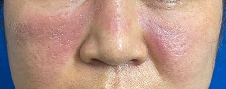 Đỏ rát mặt sau tiêm filler tạo hình mũi ở spa- Ảnh 1.