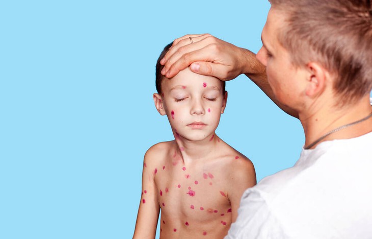 Thuốc nào dùng điều trị thuỷ đậu?- Ảnh 1.