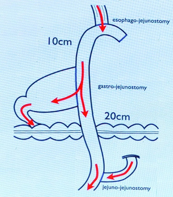 Bệnh viện Hữu nghị Đa khoa Nghệ An phát triển kỹ thuật phẫu thuật nội soi dạ dày- Ảnh 2.