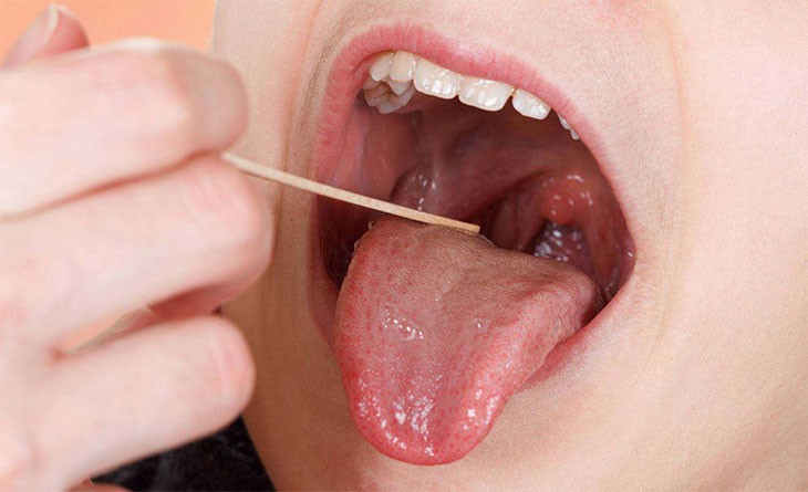 Bị ung thư lưỡi di căn hạch do chủ quan từ vết loét nhỏ- Ảnh 1.