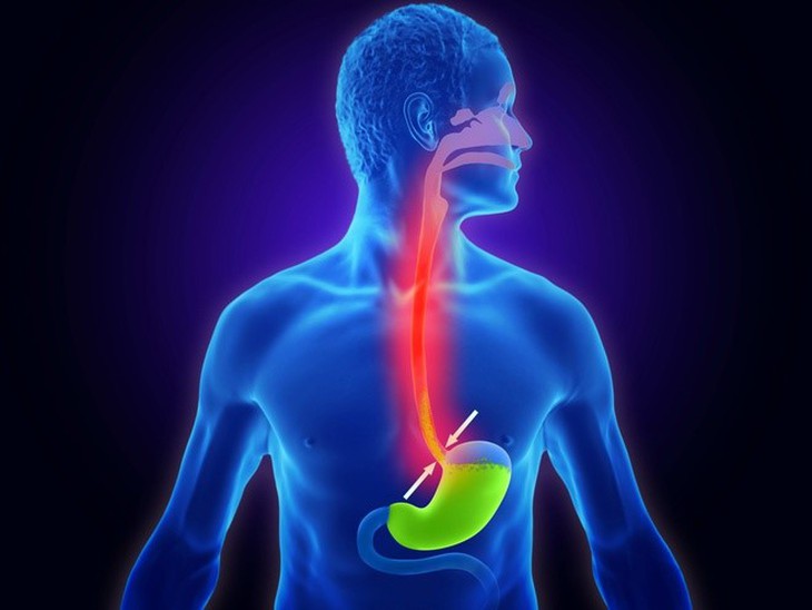 Cách hỗ trợ giảm triệu chứng trào ngược dạ dày dai dẳng lâu năm- Ảnh 1. Cách hỗ trợ giảm triệu chứng trào ngược dạ dày dai dẳng lâu năm- Ảnh 1.