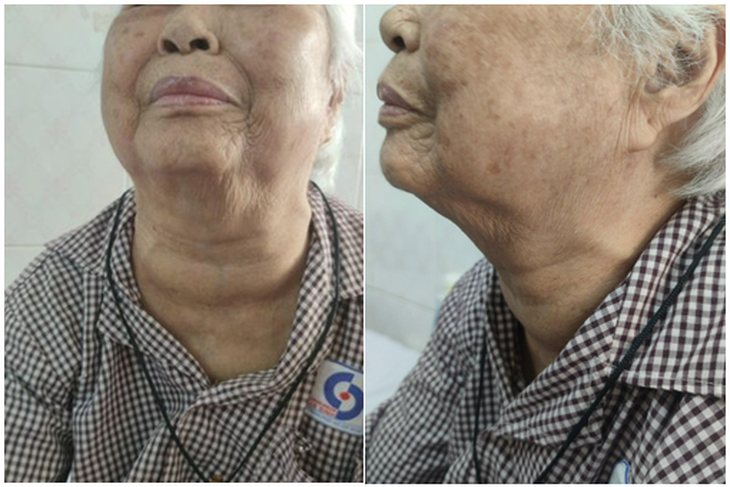 Phẫu thuật thành công cho cụ bà 95 tuổi có bướu cổ khổng lồ- Ảnh 1.