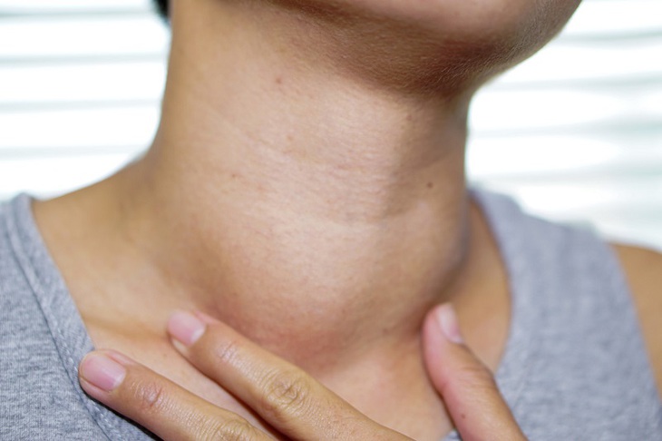 Bướu giáp lan tỏa là tình trạng bướu giáp to đều ra cả hai bên.