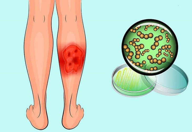 Tùy từng dạng viêm da mủ mà bác sĩ cho thuốc điều trị thích hợp, điều quan trọng là người bệnh không tự ý dùng kháng sinh, thuốc bôi, dán cao, đắp lá…