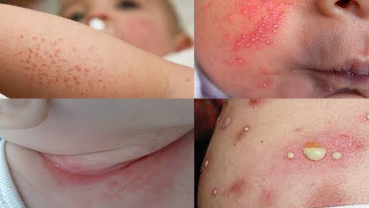 Mùa hè nóng nực, cơ thể luôn ẩm ướt do ra nhiều mồ hôi, sức đề kháng của da cũng giảm sút là điều kiện thuận lợi cho các chứng bệnh ngoài da phát triển trong đó có bệnh viêm da mủ. Ảnh minh họa