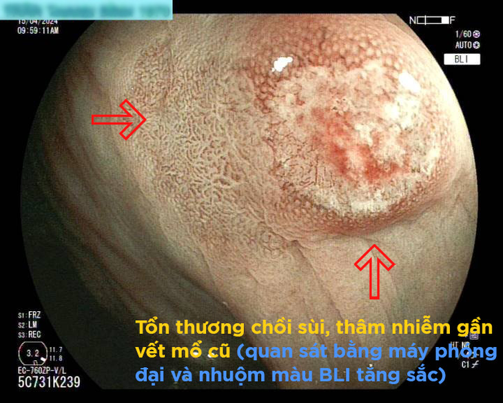 Nội soi công nghệ cao giúp tầm soát, phát hiện sớm và điều trị ung thư đường tiêu hóa- Ảnh 1. Nội soi công nghệ cao giúp tầm soát, phát hiện sớm và điều trị ung thư đường tiêu hóa- Ảnh 1.