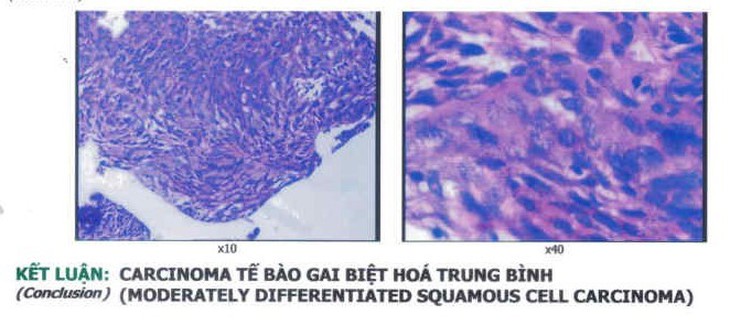 Nội soi công nghệ cao giúp tầm soát, phát hiện sớm và điều trị ung thư đường tiêu hóa- Ảnh 2. Nội soi công nghệ cao giúp tầm soát, phát hiện sớm và điều trị ung thư đường tiêu hóa- Ảnh 2.