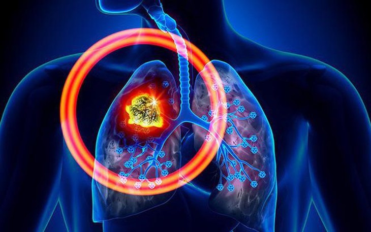 Giải đáp thắc mắc thường gặp về bệnh ung thư phổi