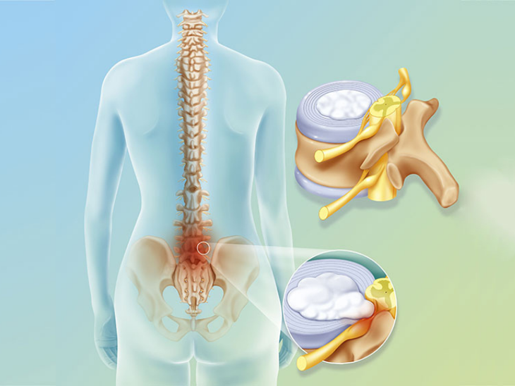 Khi tập luyện, người bệnh cần lưu ý và tuân thủ theo các hướng dẫn sau để đảm bảo sự an toàn và hiệu quả.