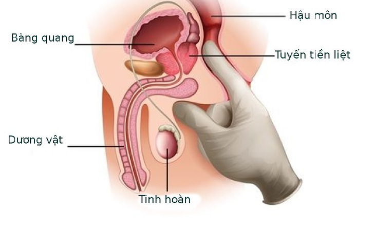 Người cao tuổi mắc u xơ tuyến tiền liệt có cần phẫu thuật?- Ảnh 1. Người cao tuổi mắc u xơ tuyến tiền liệt có cần phẫu thuật?- Ảnh 1.