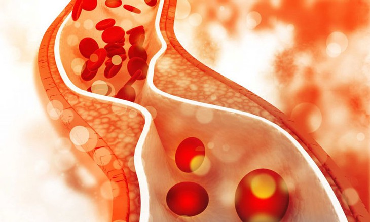 Tăng triglycerid máu gây nhiều hệ lụy và phòng ngừa hiệu quả- Ảnh 1. Tăng triglycerid máu gây nhiều hệ lụy và phòng ngừa hiệu quả- Ảnh 1.