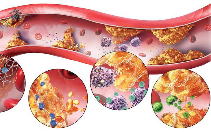 Rối loạn lipid (mỡ máu): Nguyên nhân, triệu chứng, cách điều trị và phòng bệnh
