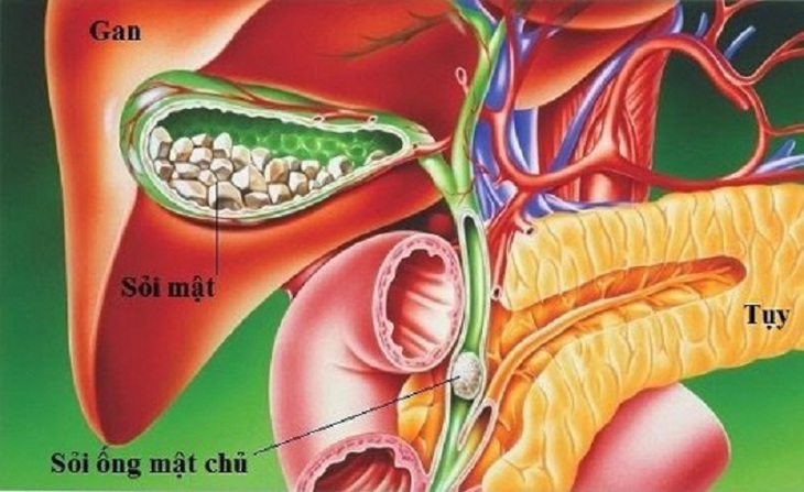Sỏi mật: Nguyên nhân, triệu chứng, điều trị và cách phòng ngừa- Ảnh 1.