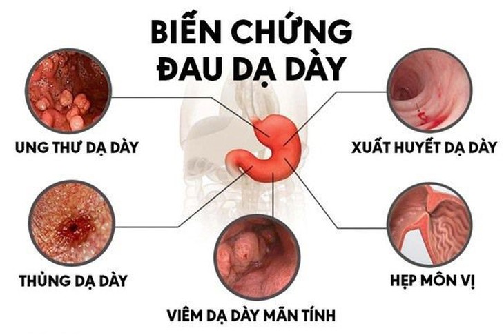Viên dạ dày plus - Bước cải tiến mới giúp hỗ trợ giảm các triệu chứng dạ dày tá tràng từ sâu bên trong- Ảnh 2.