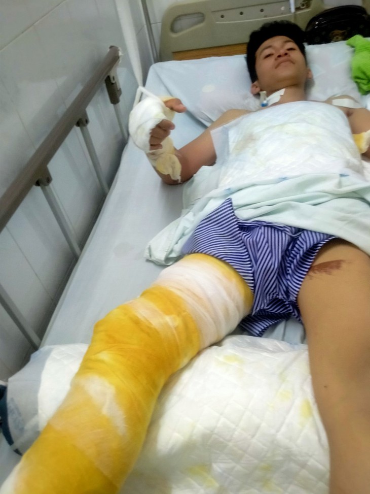 Xót thương nam thanh niên mồ côi bị bỏng nặng, có nguy cơ phải cắt bỏ cả 2 tay- Ảnh 3. Xót thương nam thanh niên mồ côi bị bỏng nặng, có nguy cơ phải cắt bỏ cả 2 tay- Ảnh 3.