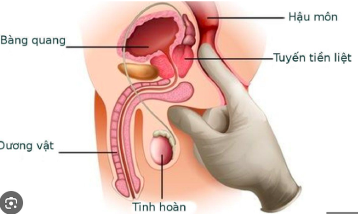 Ung thư dương vật: Nguyên nhân, biểu hiện, cách điều trị và phòng bệnh- Ảnh 1. Ung thư dương vật: Nguyên nhân, biểu hiện, cách điều trị và phòng bệnh- Ảnh 1.