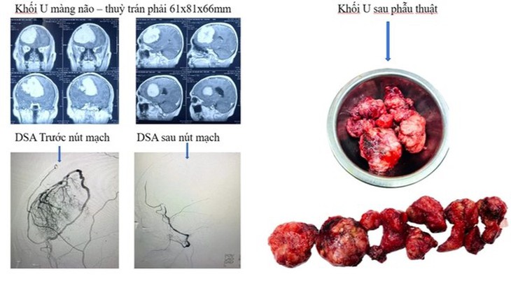 Bệnh viện Hữu nghị Đa khoa Nghệ An điều trị thành công 2 bệnh nhân có khối u não lớn, phức tạp- Ảnh 1. Bệnh viện Hữu nghị Đa khoa Nghệ An điều trị thành công 2 bệnh nhân có khối u não lớn, phức tạp- Ảnh 1.