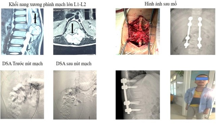 Bệnh viện Hữu nghị Đa khoa Nghệ An điều trị thành công 2 bệnh nhân có khối u não lớn, phức tạp- Ảnh 4. Bệnh viện Hữu nghị Đa khoa Nghệ An điều trị thành công 2 bệnh nhân có khối u não lớn, phức tạp- Ảnh 4.