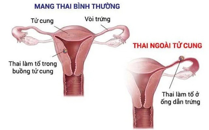 Câu hỏi thường gặp về mang thai ngoài tử cung