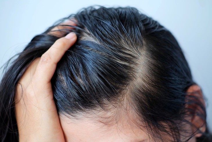 Rụng tóc nhiều vào mùa hè phải làm sao?- Ảnh 2. Rụng tóc nhiều vào mùa hè phải làm sao?- Ảnh 2.