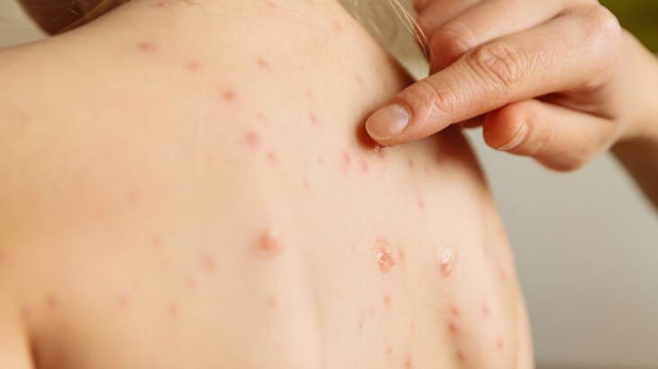 Gia tăng ca mắc sởi, hầu hết chưa tiêm vaccine, TPHCM lập tổ chuyên gia điều trị- Ảnh 1. Gia tăng ca mắc sởi, hầu hết chưa tiêm vaccine, TPHCM lập tổ chuyên gia điều trị- Ảnh 1.