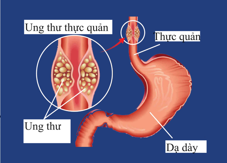 Cứu bệnh nhân ung thư thực quản bị xuất huyết dạ dày ồ ạt- Ảnh 1.