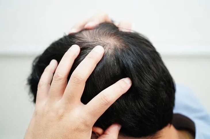 Rụng tóc kiểu 'rừng thưa', nam thanh niên bất ngờ phát hiện bệnh lây truyền qua đường tình dục- Ảnh 1. Rụng tóc kiểu 'rừng thưa', nam thanh niên bất ngờ phát hiện bệnh lây truyền qua đường tình dục- Ảnh 1.
