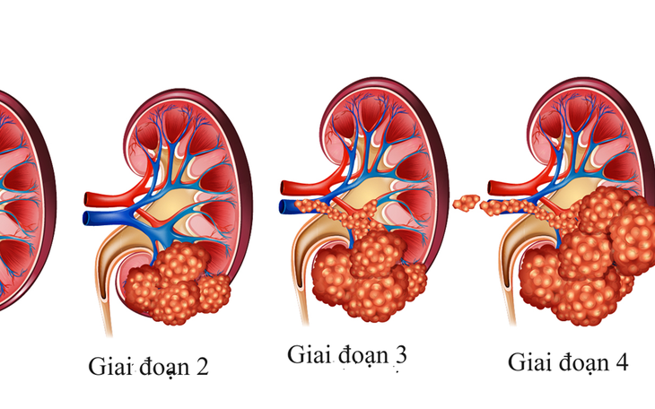 Các lựa chọn điều trị ung thư thận
