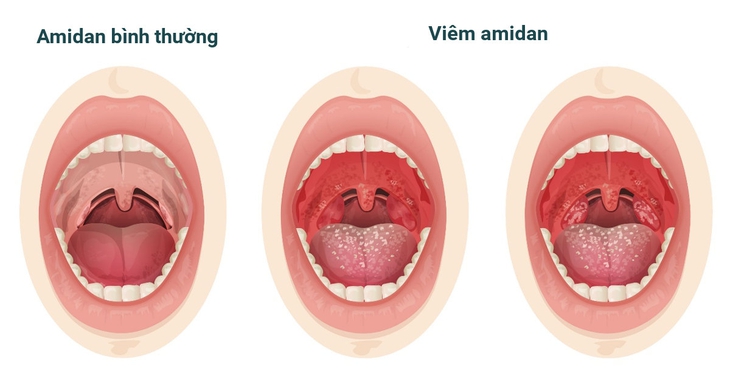 9 câu hỏi thường gặp liên quan đến bệnh viêm amidan- Ảnh 1. 9 câu hỏi thường gặp liên quan đến bệnh viêm amidan- Ảnh 1.