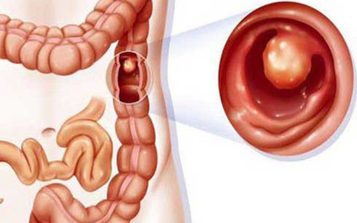 Điều trị ung thư đại tràng như thế nào?