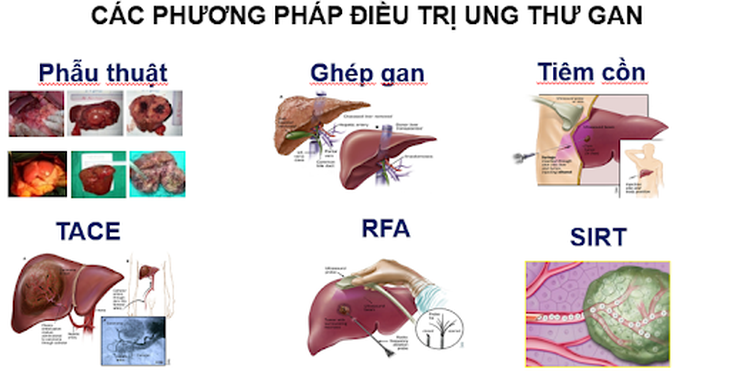 Ung thư gan có chữa khỏi được không?- Ảnh 1. Ung thư gan có chữa khỏi được không?- Ảnh 1.