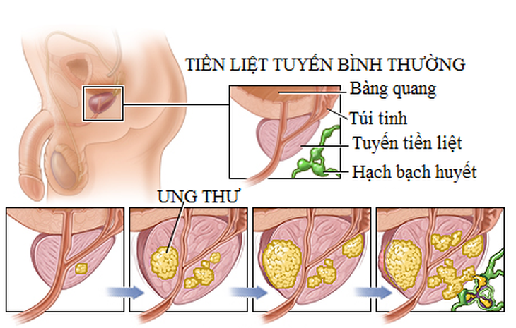 Bài tập cải thiện thể chất và tinh thần cho người bệnh ung thư tuyến tiền liệt- Ảnh 1. Bài tập cải thiện thể chất và tinh thần cho người bệnh ung thư tuyến tiền liệt- Ảnh 1.