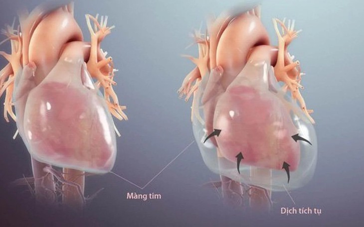 Viêm màng ngoài tim: Nguyên nhân, triệu chứng, cách điều trị và phòng ngừa