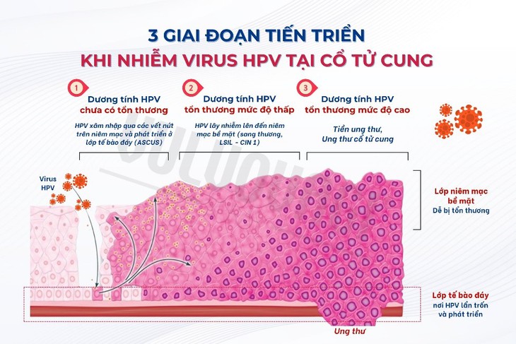 Nhiễm HPV ở cổ tử cung: cách nào giúp cơ thể đẩy nhanh khả năng tự đào thải HPV?- Ảnh 1. Nhiễm HPV ở cổ tử cung: cách nào giúp cơ thể đẩy nhanh khả năng tự đào thải HPV?- Ảnh 1.
