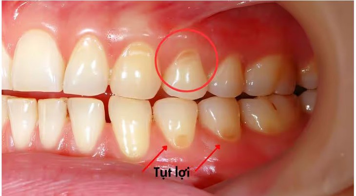 Tụt lợi có chữa được không?- Ảnh 1. Tụt lợi có chữa được không?- Ảnh 1.