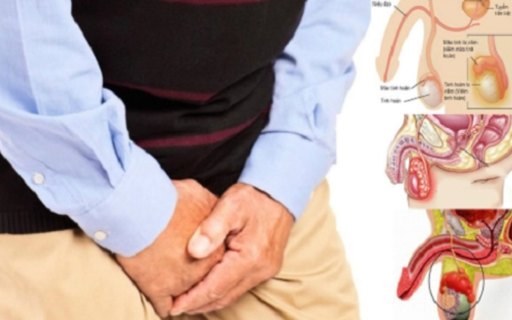 Viêm mào tinh hoàn: Nguyên nhân, triệu chứng và cách điều trị