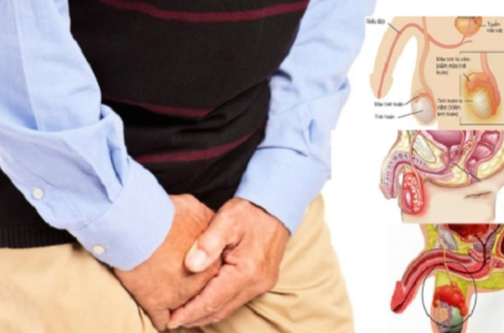 Viêm mào tinh hoàn: Nguyên nhân, triệu chứng và cách điều trị- Ảnh 1.