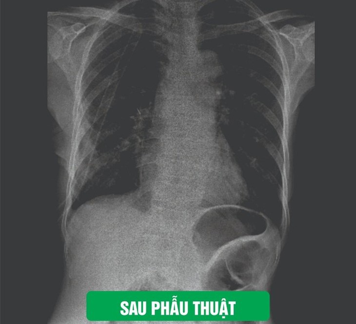Bệnh viện Đa khoa TP Vinh phẫu thuật cắt thuỳ phổi bằng nội soi- Ảnh 3.