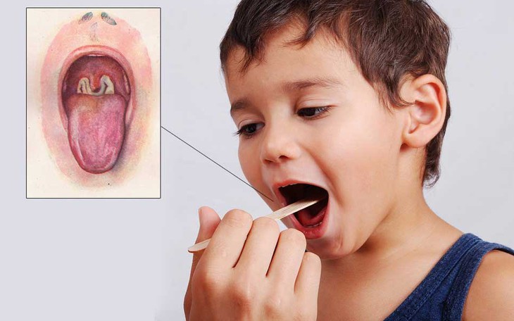 Thuốc điều trị bệnh bạch hầu thanh quản
