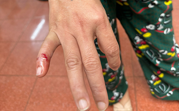 Chó nhiễm virus dại cắn 4 người dân ở Đắk Lắk