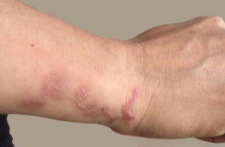 Các phương pháp điều trị nhiễm ấu trùng sán lợn- Ảnh 1.