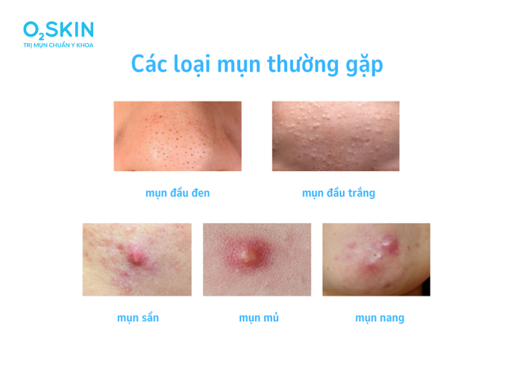 Phân biệt các loại mụn trên mặt và cách điều trị hiệu quả- Ảnh 1. Phân biệt các loại mụn trên mặt và cách điều trị hiệu quả- Ảnh 1.